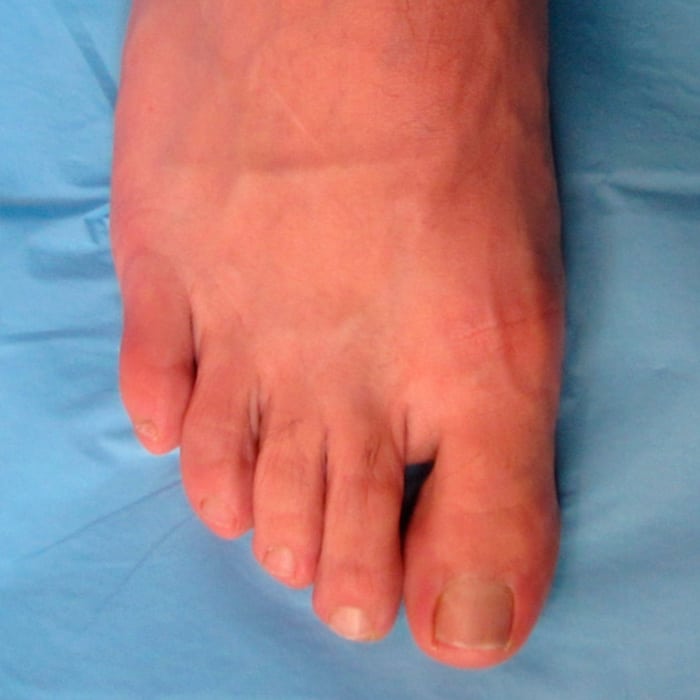 Deformidades dedos menores - despues