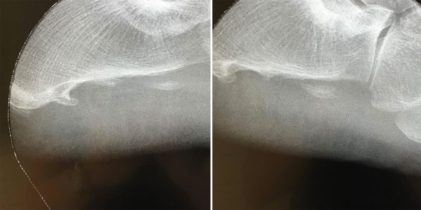 Espolón calcáneo antes y después de tratamiento con ondas de choque