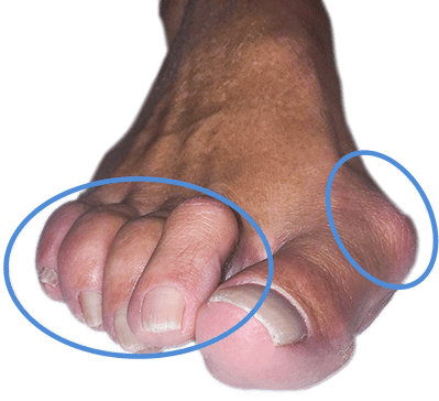 Juanete hallux valgus en pie real