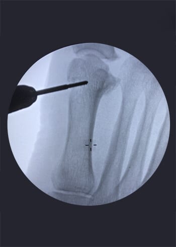 Rdiografia de limado de hueso del pie Hallux Valgus