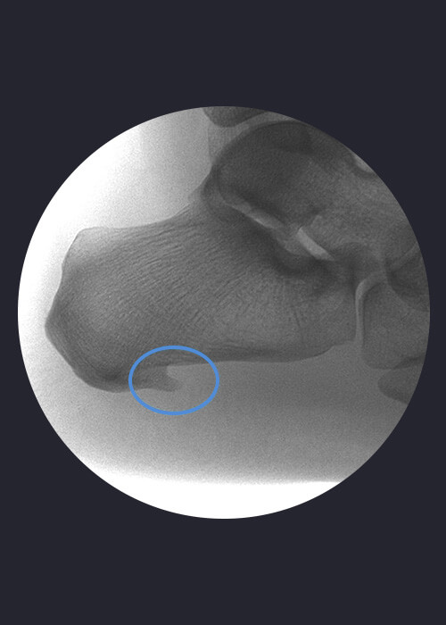 Radiografía de espolón calcáneo