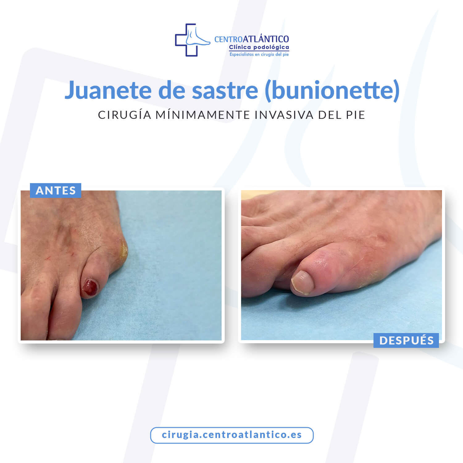 Antes y después juanete de sastre