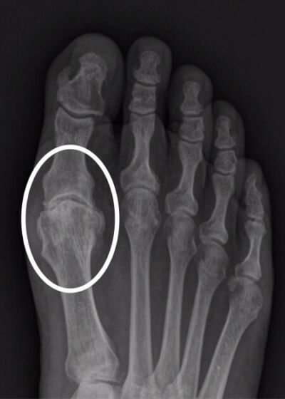 Hallux rigidus o artrósis metatarsofalángica , cómo resolverlo - Centro ...