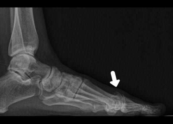 Hallux rigidus o artrósis metatarsofalángica , cómo resolverlo - Centro ...