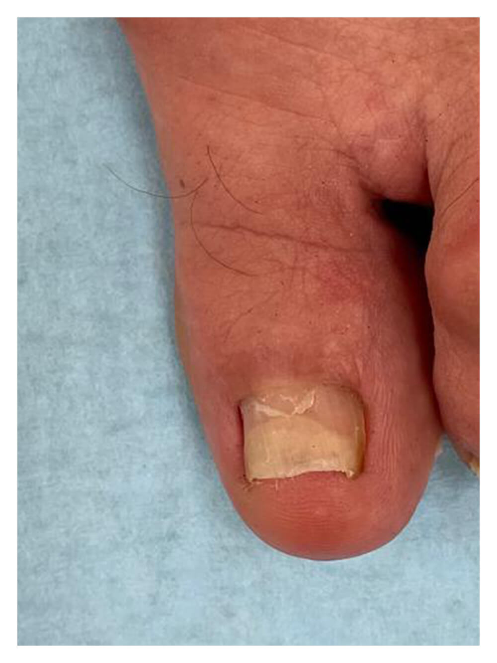 Exostosis subungueal pie