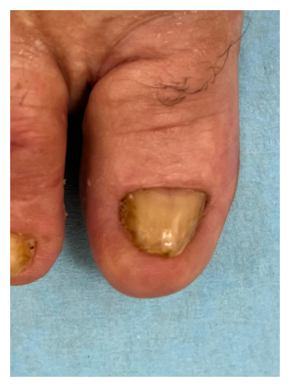 Distrofia ungueal por exostosis en el pie